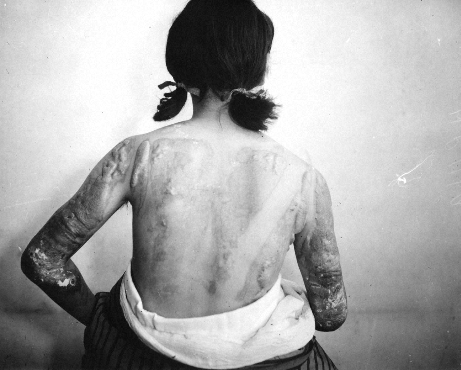 A Woman with Keloids on Her Back and Both Arms