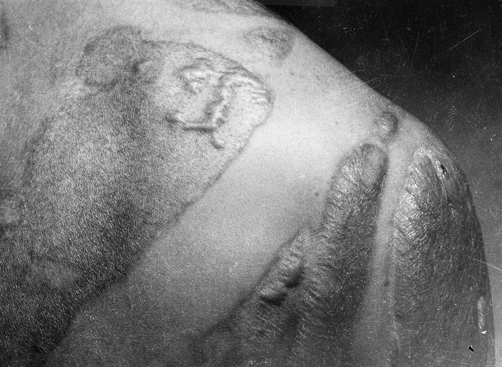 Keloids