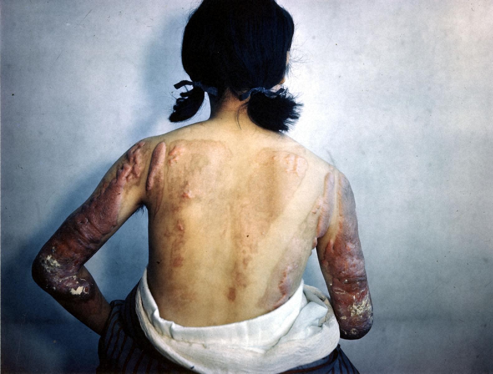 Color photo of a Woman with Keloids on Her Back and Both Arms
