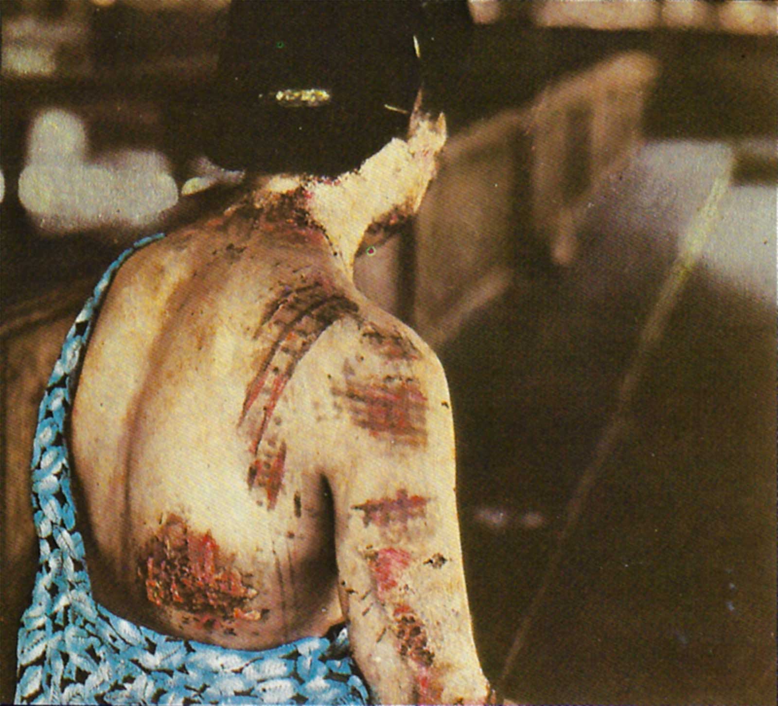 The patient’s skin is burned in a pattern corresponding to the dark portions of a kimono worn at the time of the explosion